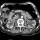 Hypertrophy of bladder wall, urinary bladder, hydronephrosis, CT cystography: CT - Computed tomography